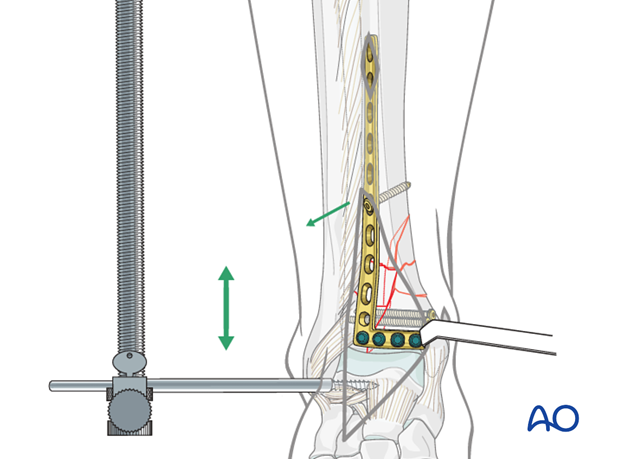 Metaphyseal reduction for plate fixation to treat distal tibia fractures