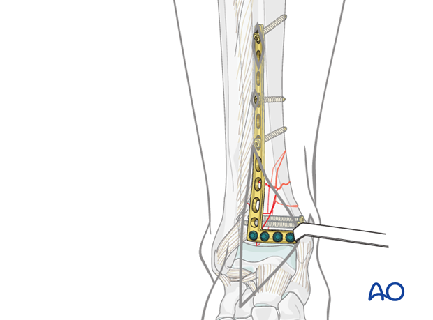 Definitive plate fixation to treat complete articular distal tibia fractures
