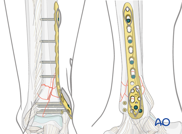 Alternative: MIO fixation to treat complete articular distal tibia fractures