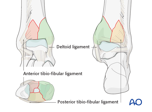 3-part articular fracture of the distal tibia