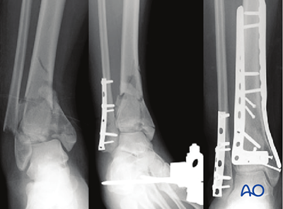 ORIF - Plate and screws through anterolateral approach for Complete ...