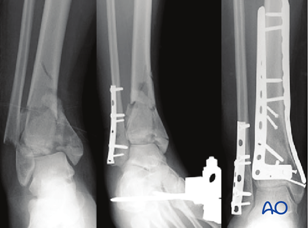 Distal Tibia Plate Surgical Technique