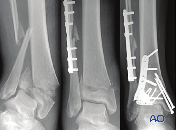 Example of complete articular fracture of the distal tibia treated with screws and plate fixation