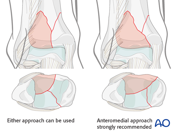 anteromedial or anterolateral approach