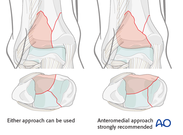 43_P170_i060 anteromedial or anterolateral approach