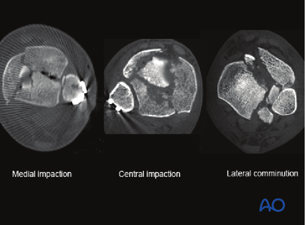 Imaging examples of complete articular multifragmentary fractures of the distal tibia with impaction and comminution