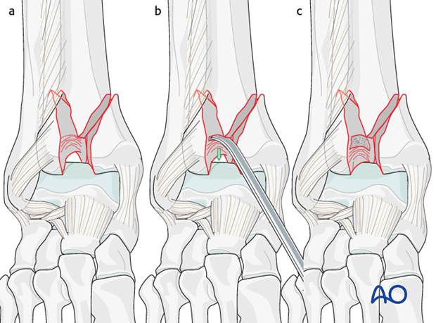Medial comminution and impaction in a complete articular multifragmentary fracture of the distal tibia