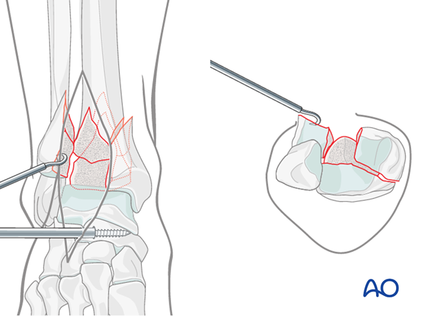 Cleaning the fracture site in a distal tibia fracture