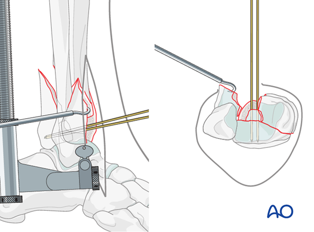 Reduction of the centrally impacted segment in a complete articular fracture of the distal tibia