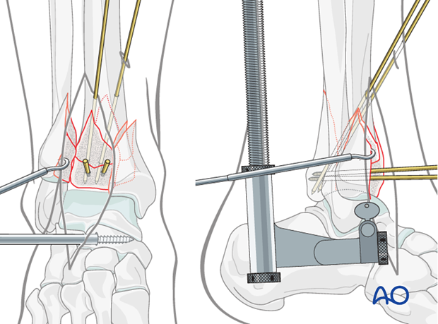 Preliminary fixation with K-wires of the posterolateral fragment in a complete articular fracture of the distal tibia