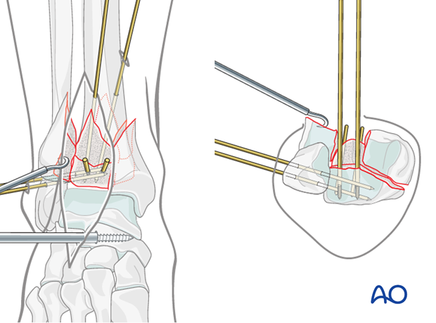 Preliminary fixation with K-wires of the posterolateral fragment in a complete articular fracture of the distal tibia
