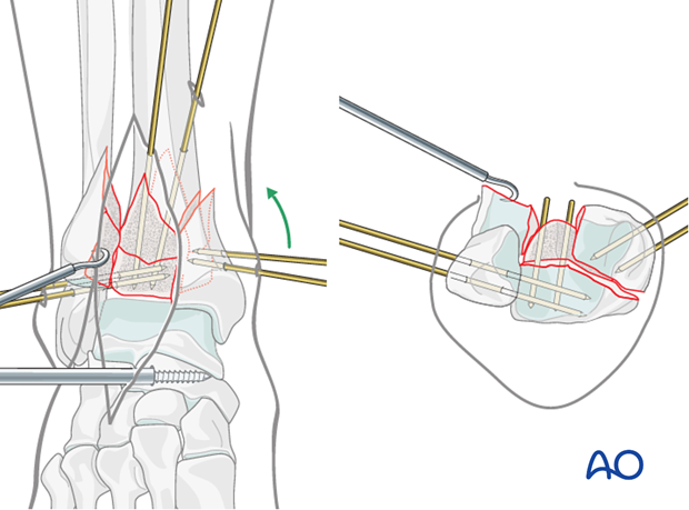 Preliminary fixation of the medial fragment in a complete articular fracture of the distal tibia