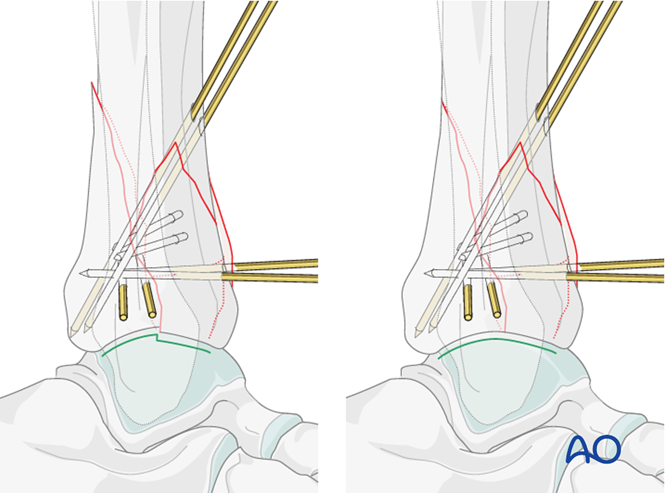 Oref Leg ORIF - Plate and screws through anterolateral approach for Complete ...