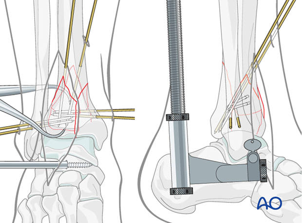 Preliminary fixation of the anterolateral fragments in a complete articular fracture of the distal tibia