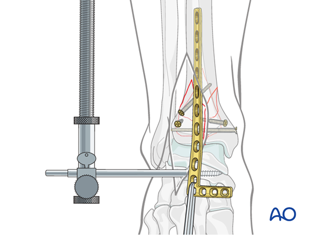 Lateral plate fixation in a complete articular fracture of the distal tibia