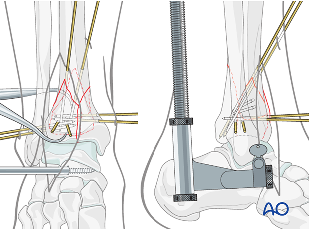 Stabilization of the anterolateral fragments in a complete articular fracture of the distal tibia