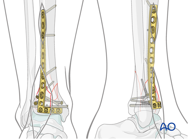 Proximal screw placement in lateral plate fixation in a complete articular fracture of the distal tibia