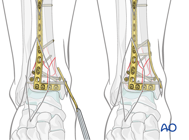 Medial side fixation in a complete articular fracture of the distal tibia
