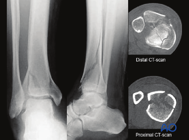 Imaging example of a distal tibia fracture with proximal diaphyseal extensions