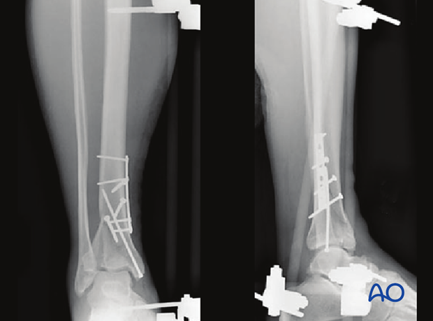 Imaging example of a distal tibia fracture with proximal diaphyseal extensions fixed with plate