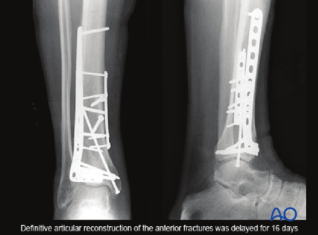 Imaging example of definitive fixation of a distal tibia fracture with proximal diaphyseal extensions
