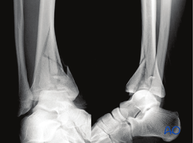 Imaging example of a 3-part multifragmentary complete articular distal tibia fracture