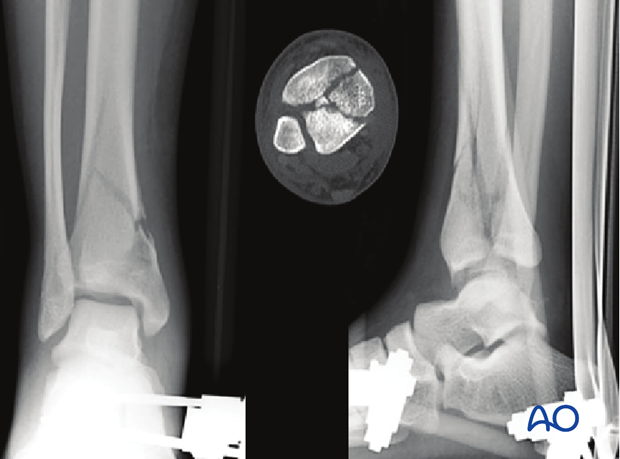 Imaging example of initial management of a 3-part multifragmentary complete articular distal tibia fracture