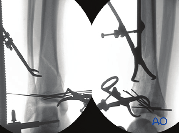 Intraoperative fluoroscopy for fixation of a 3-part multifragmentary complete articular distal tibia fracture