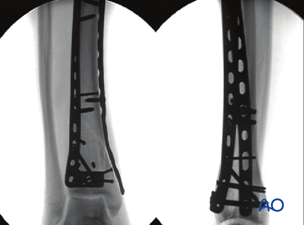 Fluoroscopic image of definitive plate fixation of a 3-part multifragmentary complete articular distal tibia fracture