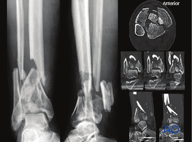 Imaging example of a pilon fracture of distal tibia with displaced central fragments