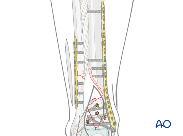 Proximal plate fixation in a complete articular multifragmentary distal tibia fracture