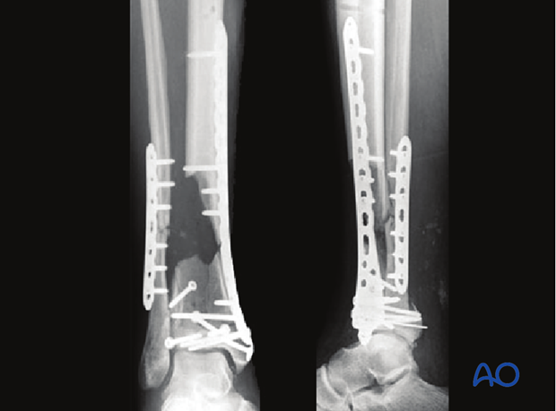 Reduction and fixation assessment of a complete articular multifragmentary distal tibia fracture