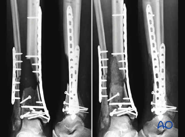 Radiographic example of large defect bone grafting to treat a complete articular multifragmentary distal tibia fracture