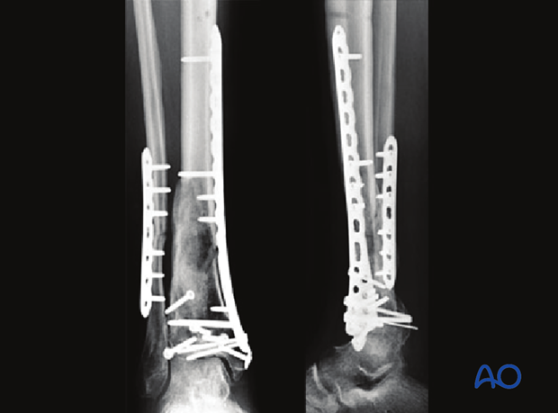 Radiographic example of a complete articular multifragmentary distal tibia fracture treated with traditional cloverleaf plate