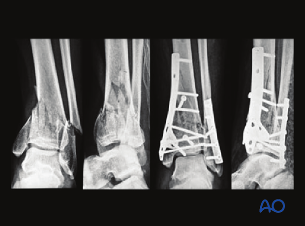 Example of a complete articular multifragmentary distal tibia fracture treated with double-plate technique