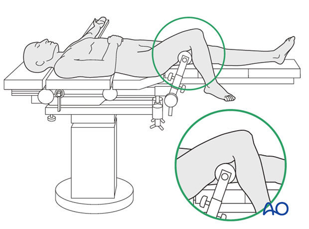 Supine position on a radiolucent table with knee support