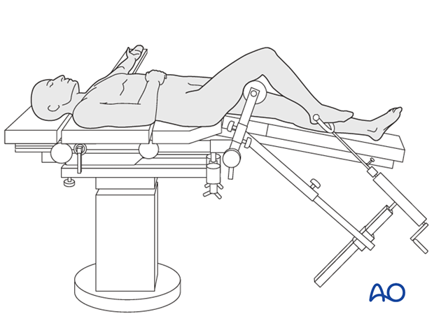 Supine position on a radiolucent traction table