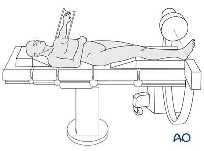 Temporary joint-bridging triangular external fixation for Complete ...