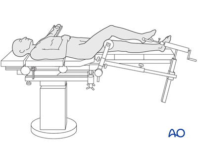 Full ring external fixation (Ilizarov) for Extraarticular, simple fracture