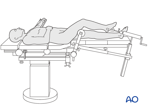 Medical Ring Fixator for Tibial & Femur Fracture in Orthopedic Tibia  Industry - China Ilizarov, Ortopedi Ilizarov