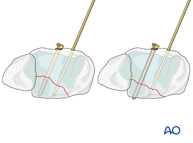 Lag screw principles