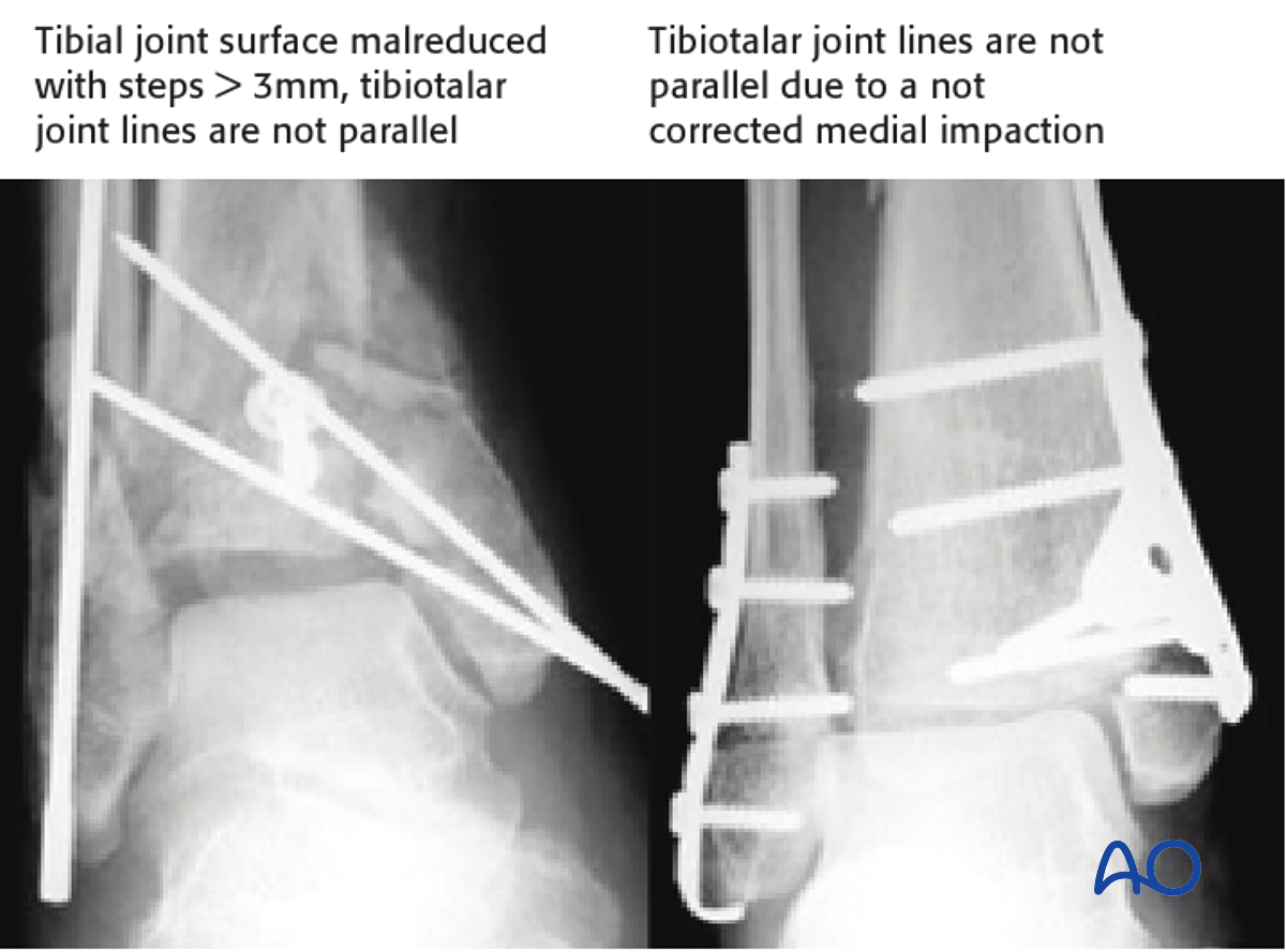 Assessment Of Reduction Of Type B Distal Tibial Pilon Fractures