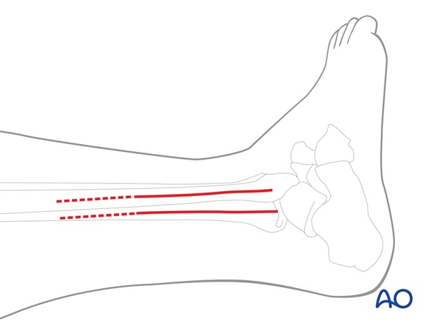lateral approach