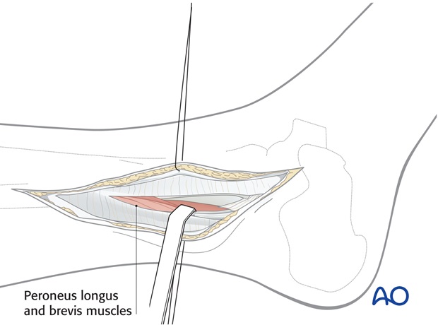 lateral approach for high fibular fractures