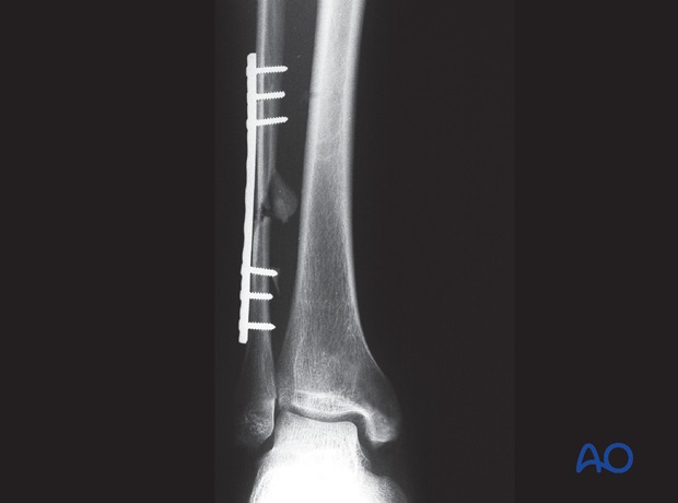 fibula multifragmentary c fracture lateral bridging plate