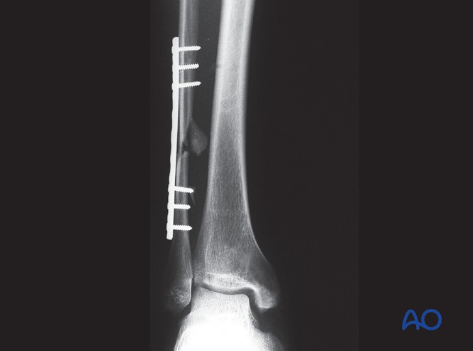 Fibula, multifragmentary fracture: lateral bridging plate
