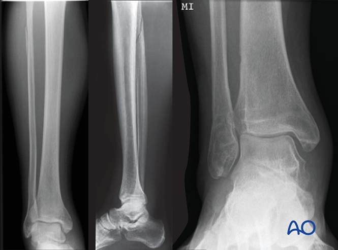 Syndesmosis injury: Fibulo-tibial positioning screw