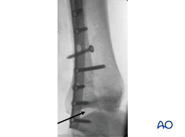 syndesmosis injury fibulo tibial positioning screw