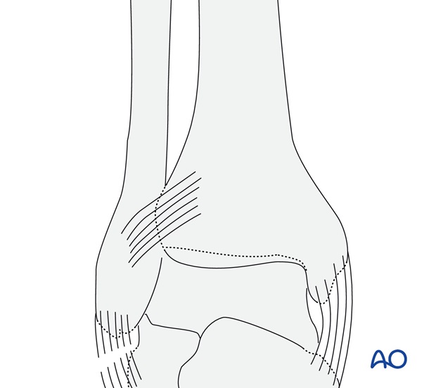 Rupture of the lateral collateral ligaments (AO/OTA 44A1.1)