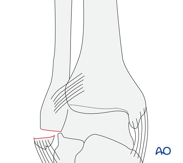 Avulsion of the tip of the lateral malleolus (AO/OTA 44A1.2)